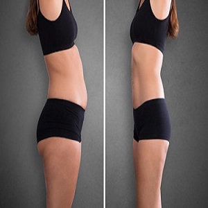 BodyTite Liposuction Before & After clinc Islamabad