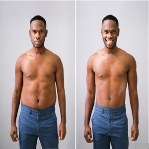 BodyTite Liposuction Before & After in Islamabad