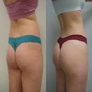 Brazilian Butt Lift Before & After