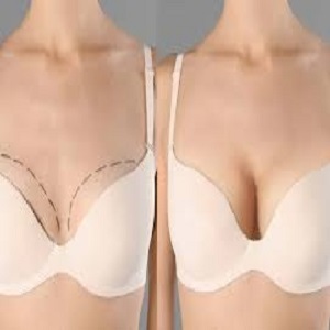 Breast Filler Injections before and After in clinic islamabad