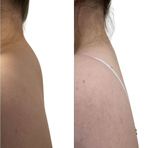 Buffalo Hump Removal Before & After in Islamabad