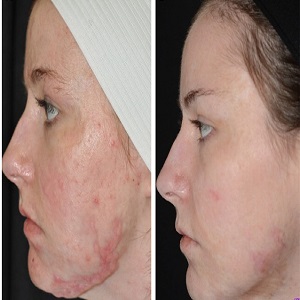 Burn Reconstructive Before & After