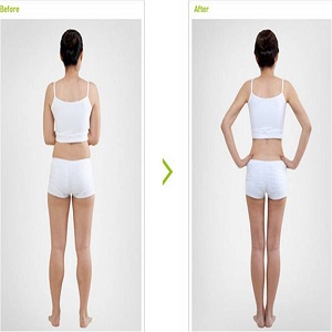 Calf Reduction Before & After clinic in islamabad