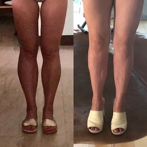 Calf Reduction Before & After clinic islamabad