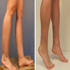Calf Reduction Before & After islamabad