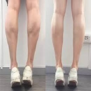 Calf Reduction Before & After clinic islamabad