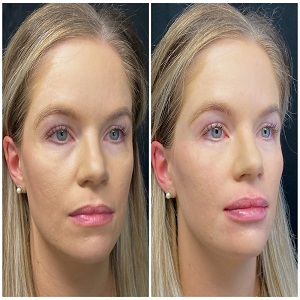 Cheek Augmentation Before & After clinic Islamabad