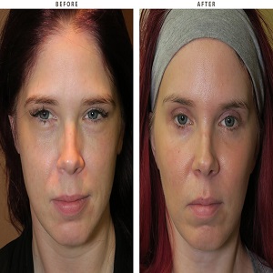 Cheek Augmentation Before & After