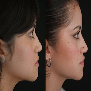 Chin Reduction Before & After in Islamabad
