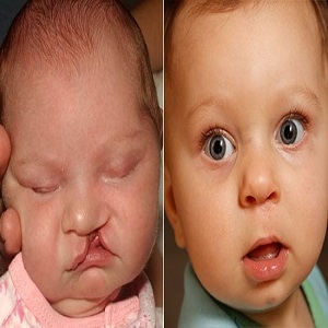 Cleft Lip & Palate Surgery Before & After in Islamabad