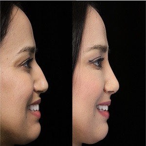 Closed Rhinoplasty Before & After