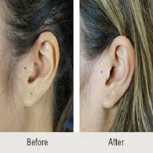 Ear Piercing Before & After Islamabad