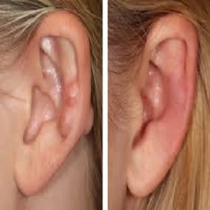 Ear Piercing Before & After in Islamabad