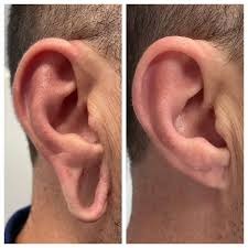 Earlobe Correction Surgery Before & After Clinic in Islamabad