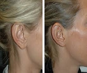 Earlobe Correction Surgery Before & After Islamabad