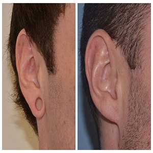 Earlobe Correction Surgery Before & After Islambad Pakistan