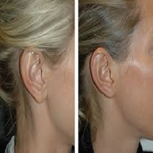 Earlobe Correction Surgery Before & After clinic in Islambad Pakistan