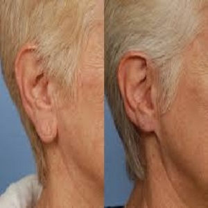 Earlobe Correction Surgery Before & After in Islamabad