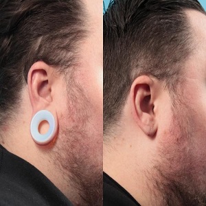 Earlobe Correction Surgery Before & After