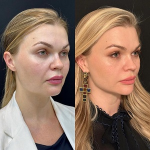 Endolift Surgery Before & After clinic in islamabad