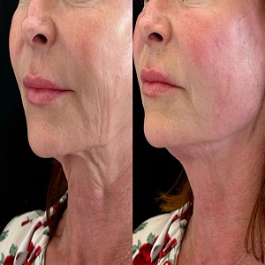 Endolift Surgery Before & After