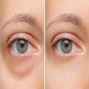 Eye Bag Removal Before & After