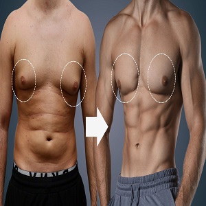 Gynecomastia Male Breast Reduction Before & After Islamabad