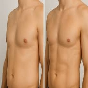 Gynecomastia Male Breast Reduction Before & After clinic in Islamabad