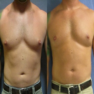 Gynecomastia Male Breast Reduction Before & After