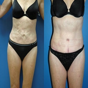 High Definition Liposculpture Before & After Islamabad