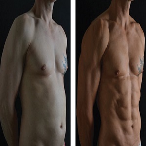 High Definition Liposculpture Before & After