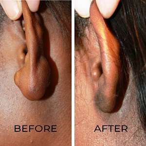 Keloid Treatment before & After