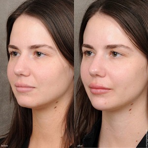 Lip Augmentation Before & After clinic in islamabad