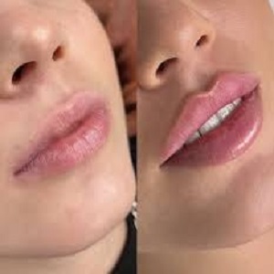 Lip Augmentation Before & After clinic islamabad