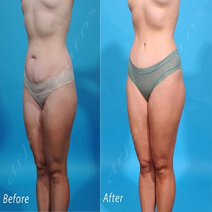 Lipo Abdominoplasty Before & After clinic in Islamabad