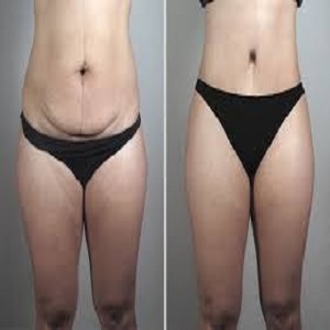 Lipo Abdominoplasty Before & After in Islamabad