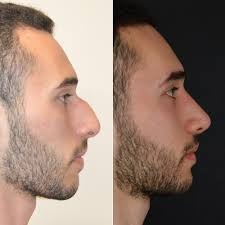 Male Rhinoplasty Before & After clinic Islamabad