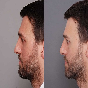 Male Rhinoplasty Before & After clinic in Islamabad