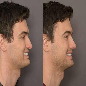 Male Rhinoplasty Before & After
