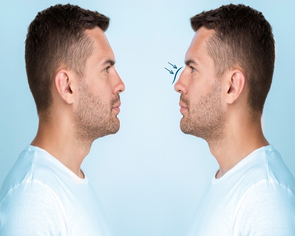 Male Rhinoplasty in Islamabad Pakistan