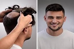 Men Hair Wigs before and After Islamabad Pakistan