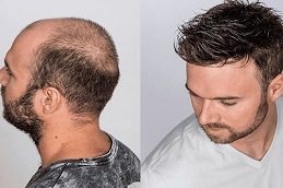 Men Hair Wigs before and After Islamabad