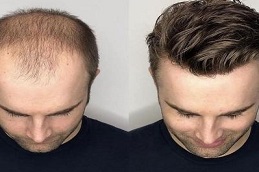 Men Hair Wigs before and After clinic Islamabad