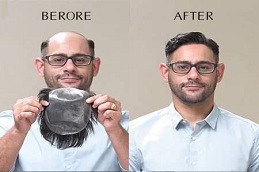 Men Hair Wigs before and After in Islamabad Pakistan