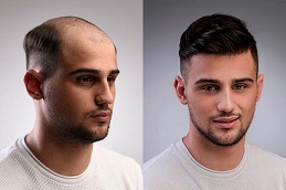 Men Hair Wigs before and After in Islamabad