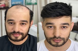 Men Hair Wigs before and After