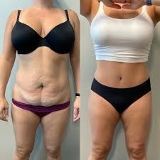 Mini Abdominoplasty Before & After Islamabad