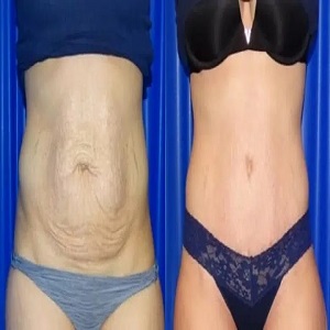 Mini Abdominoplasty Before & After clinic in Islamabad