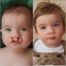 Palate Repair Surgery before & After in islamabad