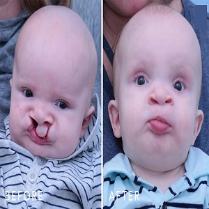 Palate Repair Surgery before & After